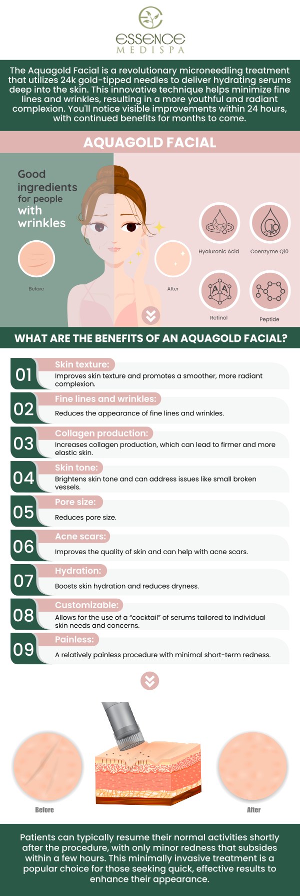 Aqua Gold Micro Channeling is a minimally invasive skin rejuvenation treatment that delivers a customized blend of vitamins, hyaluronic acid, or other beneficial ingredients directly into the skin. This innovative approach addresses various skin concerns, such as fine lines, wrinkles, acne scars, uneven texture, and dehydration. Aqua Gold micro channeling is offered at Essence MediSpa under the supervision of Stephen Weinman, MD, and Jennifer Pena. For more information, please contact us or book an appointment. We are located at 222 NY-299 Suite A, Highland, NY 12528.