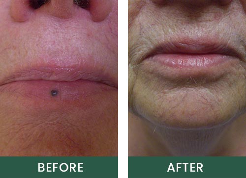 Mole Removal Treatment Before and After Photos of Essence MediSpa Clients in Highland, Poughkeepsie NY Mole Removal Treatment Before and After Photos of Essence MediSpa Clients in Highland, Poughkeepsie NY